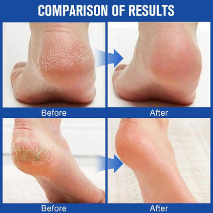 Salicylic Acid & Urea Hand and Foot Care Stick – Anti-Crack Moisturizing Balm